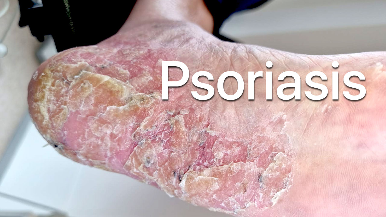 Psoriasis